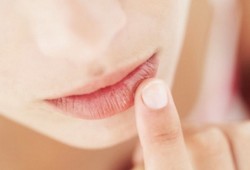 Treating the common cold sore